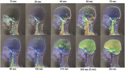 Dynamic 18F-FDG-PET kinetic parameters for epileptogenic zone localization in drug-resistant epilepsy